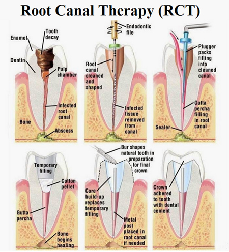 Root canal treatment